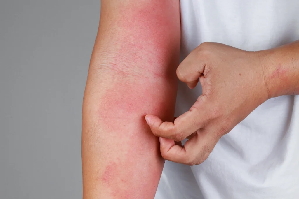 Does CBD Help With Allergies? What You Need To Know!